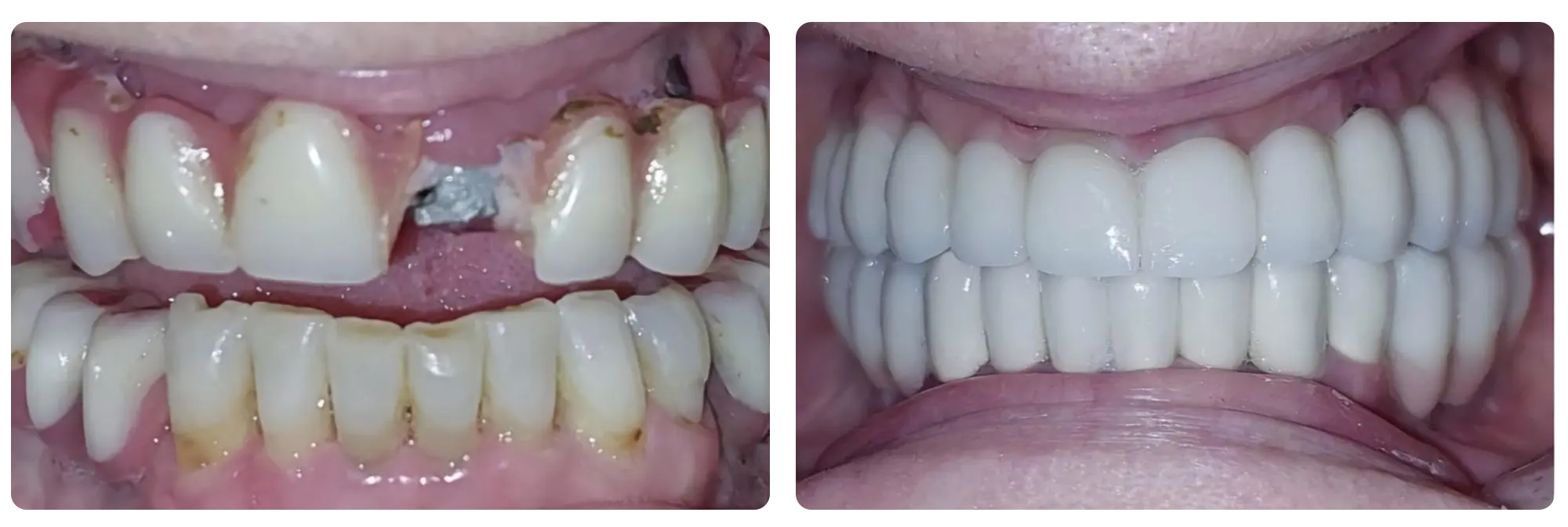 Implant Dentar 1