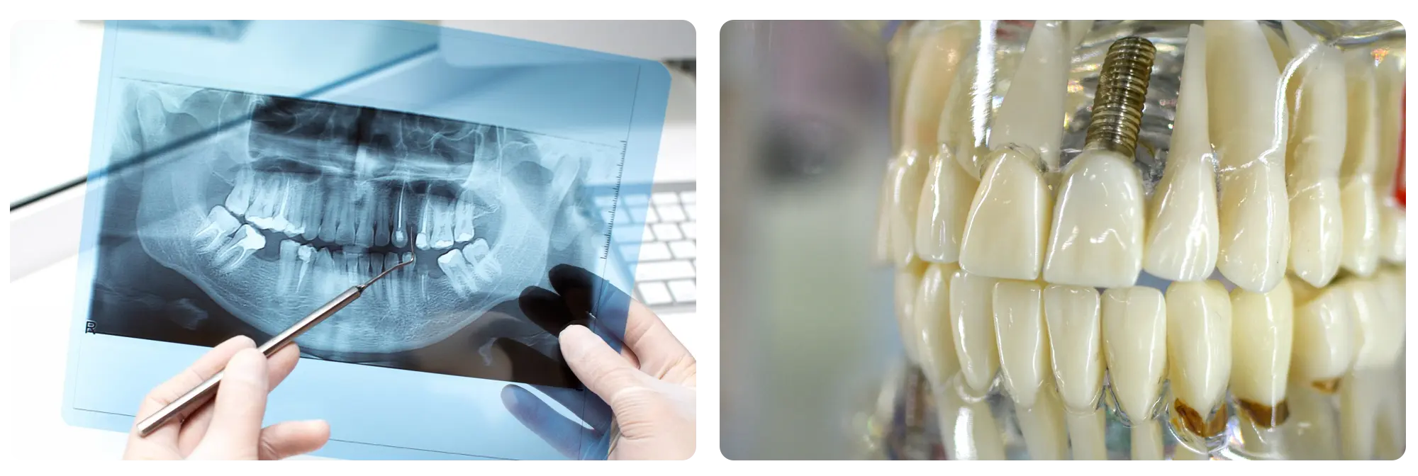Implant Dentar 3 (1)