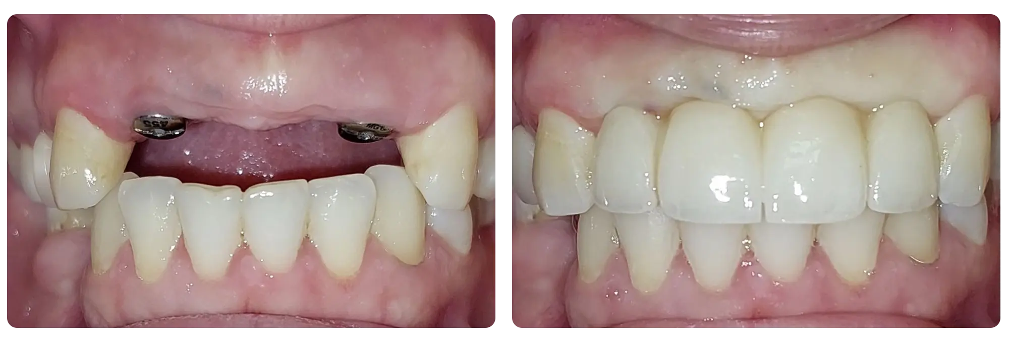 Implant Dentar 4 (1)